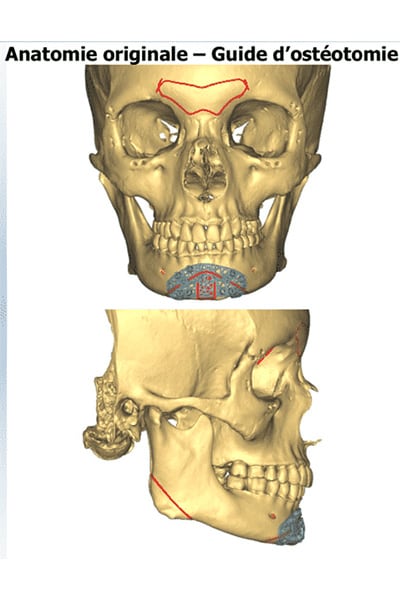 genioplastie fonctionnelle anatomie originale homme chirurgie esthetique visage paris docteur jerry levy chirurgien esthetique paris