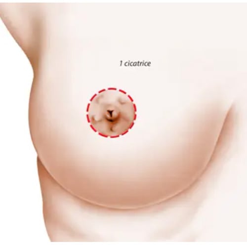lifting mammaire cicatrice ptose mammaire 1 cicatrice chirurgie mammaire paris docteur levy jerry chirurgien esthetique paris