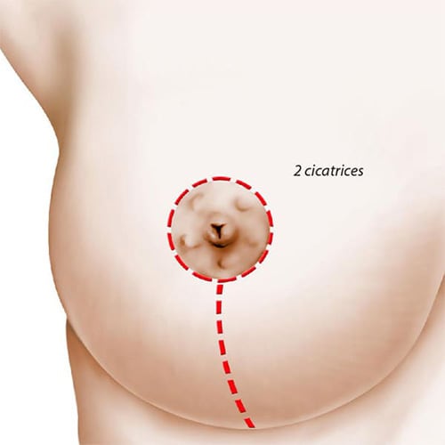 lifting mammaire cicatrice ptose mammaire 2 cicatrices chirurgie mammaire paris docteur levy jerry chirurgien esthetique paris