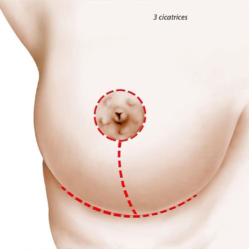 lifting mammaire cicatrice schema ptose mammaire 3 cicatrices chirurgie mammaire paris docteur levy jerry chirurgien esthetique paris
