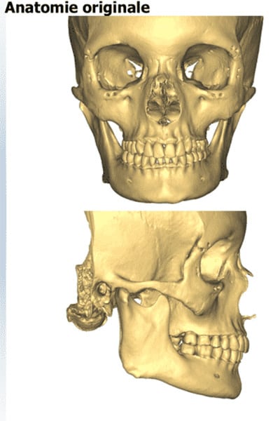 operation menton genioplastie douleur anatomie original chirurgie esthetique visage paris docteur jerry levy chirurgien esthetique paris
