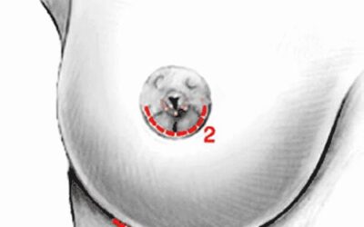 Pose de prothèses mammaires