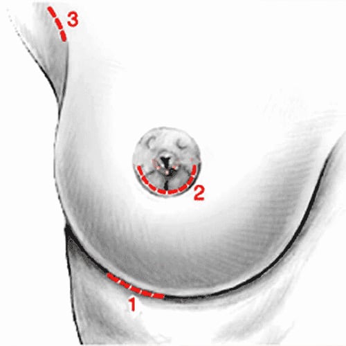 schema protheses mammaires voies d abord chirurgie mammaire paris docteur levy jerry chirurgien esthetique paris