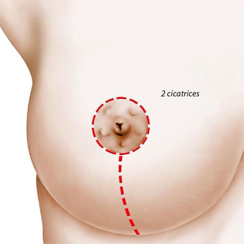 schema reduction mammaire 2 cicatrices chirurgie mammaire paris docteur levy jerry chirurgien esthetique paris