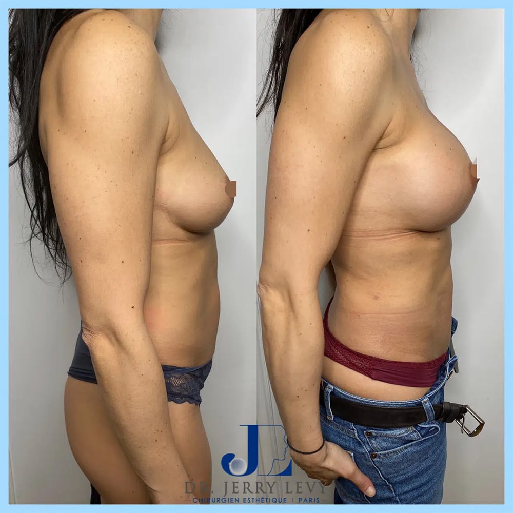 augmentation mammaire implant photo profil protheses mammaires avant apres resultat paris dr levy jerry chirurgien esthetique paris