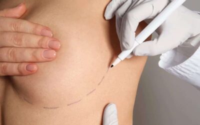 Comment est la cicatrice d’un lipofilling mammaire ?
