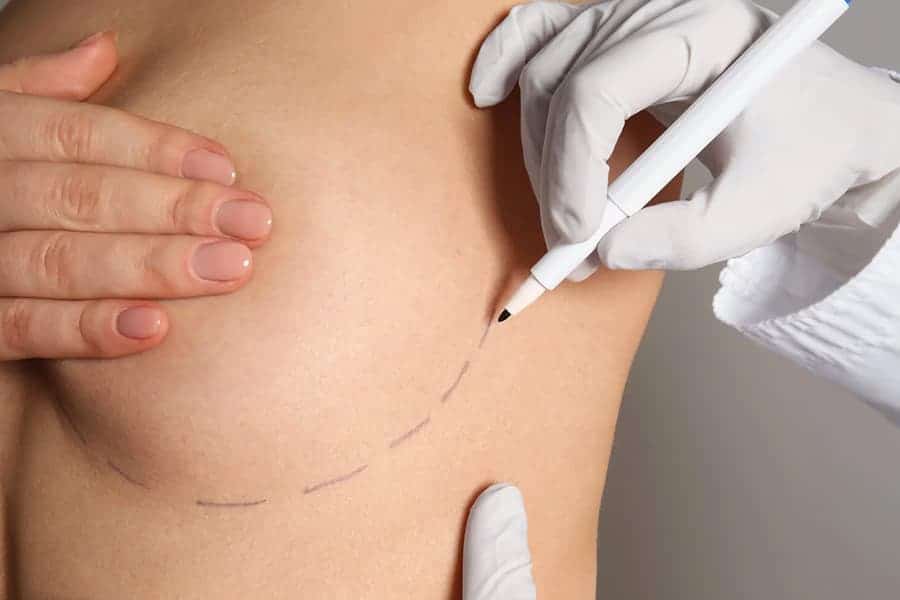 cicatrice lipofilling mammaire chirurgie mammaire paris dr jerry levy chirurgien esthetique paris