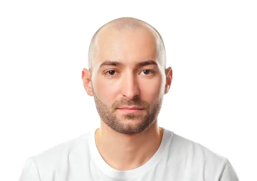 calvitie homme jeune docteur jerry levy chirurgien esthetique specialiste greffe cheveux paris