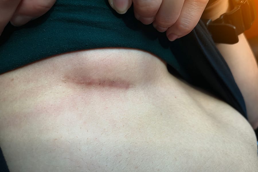 trou cicatrice reduction mammaire chirurgie du sein docteur jerry levy chirurgien esthetique chirurgie mammaire paris